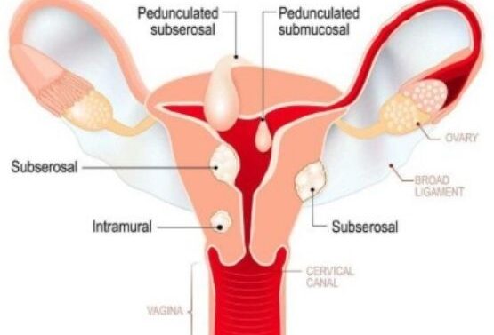 Gynaecological Disorders